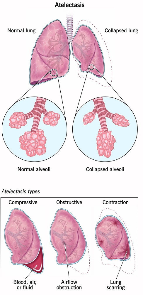 PATHOPHYSIOLOGY  OF  ATELECTASIS,  RISK  FACTORS  OF  ATELECTASIS,  MANAGEMENT  PRACTICES  OF  ATELECTASIS,  OBSTRUCTIVE  ATELECTASIS,  COMPRESSIVE  ATELECTASIS,  ADHESIVE  OR  RELAXATION  ATELECTASIS,  RISK  FACTORS  OF  ATELECTASIS,  SYMPTOMS,  DIAGNOSIS  AND  TREATMENT  OF  DIFFERENT  TYPES  OF  ATELECTASIS  AND  PREVENTION  OF  ATELECTASIS