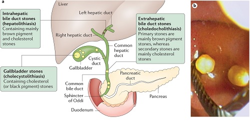 FORMATION,  CAUSES  AS  WELL  AS  RISK  FACTORS,  SYMPTOMS,  DIAGNOSIS,  TREATMENT  PREVENTION  OF  CHOLESTEROL  GALL  STONES  AND  CALCIUM  BILIRUBINATE  GALL  STONES