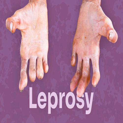 SPATIAL ANALYSIS OF LEPROSY DISEASE IN BAGALKOT DISTRICT