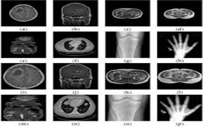 AN INTEGRATED METHOD OF DATA HIDING AND COMPRESSION OF MEDICAL IMAGES